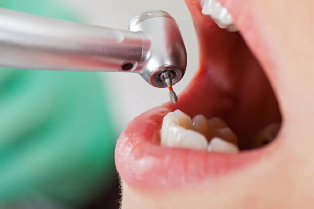 Best Emergency Wisdom Tooth Extraction in Merton, WI